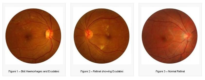 Diabetic Retinopathy