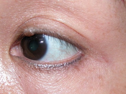 Lumps and bumps on the eyelids-Non infection types/tumours