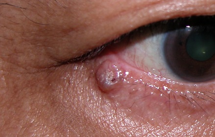 Lumps and bumps on the eyelids-Non infection types/tumours