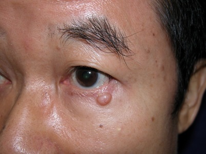 Lumps and bumps on the eyelids-Non infection types/tumours